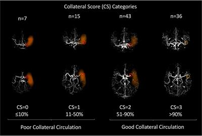 Automated scoring of collaterals, blood pressure, and clinical outcome after endovascular treatment in patients with acute ischemic stroke and large-vessel occlusion